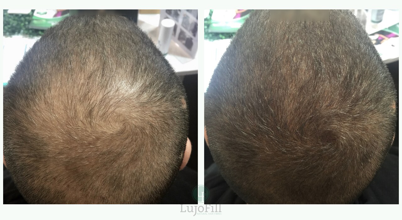 LujoFill before and after transformation showing fuller-looking crown coverage