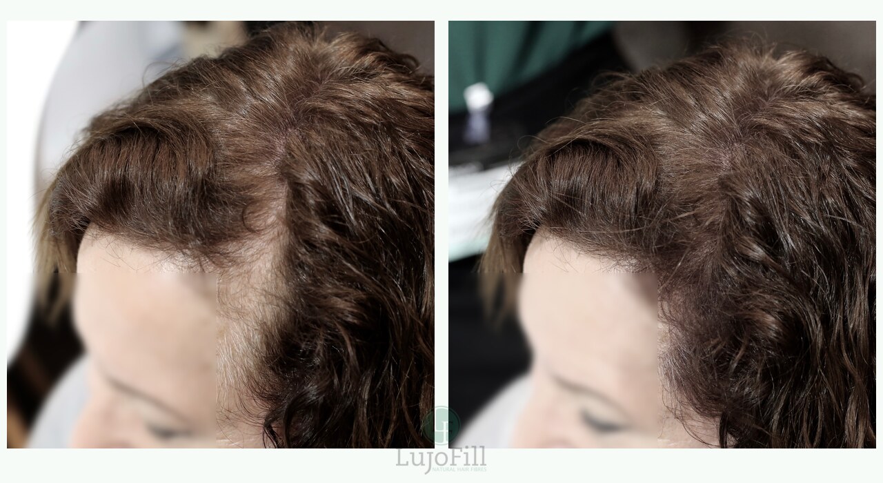 Before and after fuller hair effect around the hairline