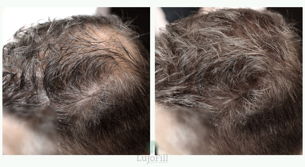 LujoFill before and after result showing fuller-looking front and crown coverage