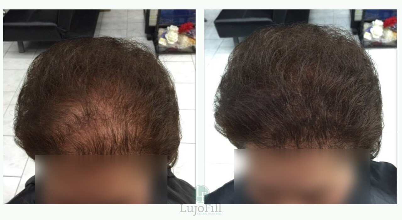 LujoFill before and after result showing natural-looking front hair coverage
